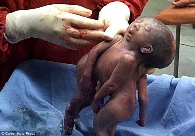 Siamese twins sharing a face have been born in Gujarat, India